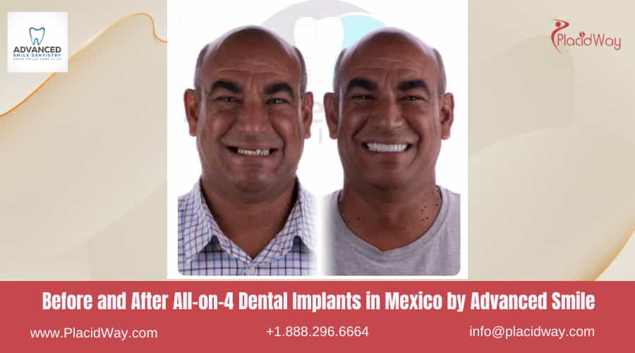All on 4 Dental Implants in Mexico Before and After Image by Advanced Smile