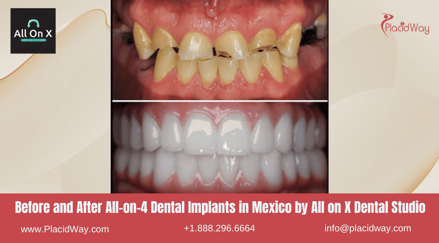 All on 4 Dental Implants in Mexico Before and After Image by All on X Dental Studio