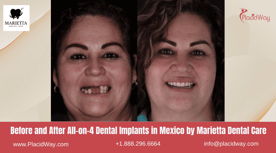 All on 4 Dental Implants in Mexico Before and After Image by Marietta Dental Care
