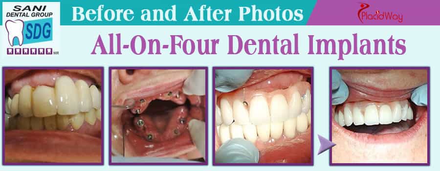 All on 4 Dental Implants in Mexico Before and After Image by SANI Dental Group