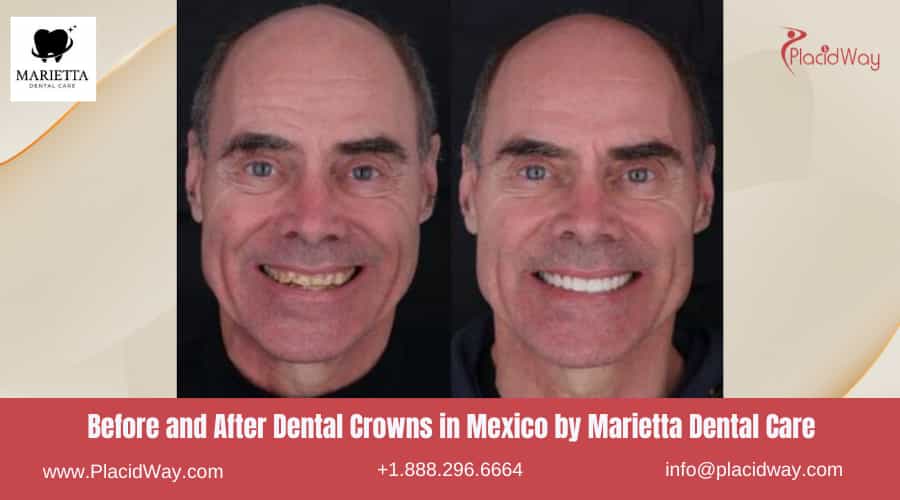 Dental Crowns in Mexico Before and After Image by Marietta