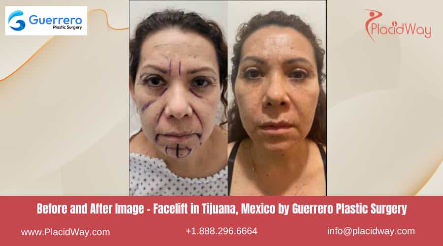 Facelift in Tijuana Mexico - Guerrero Plastic Surgery