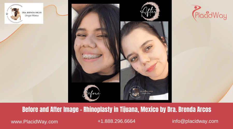 Rhinoplasty in Tijuana Mexico - Dra Brenda Arcos