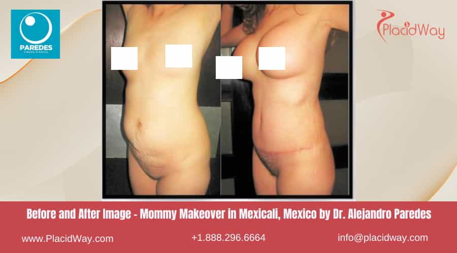 MMO in Mexicali Mexico - Dr Paredes