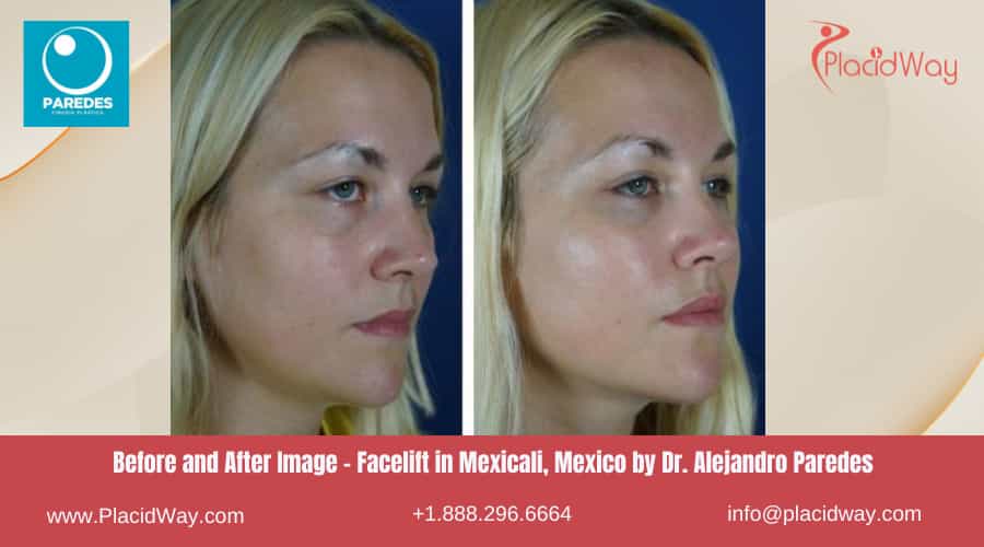 Facelift in Mexicali Mexico by Dr Paredes