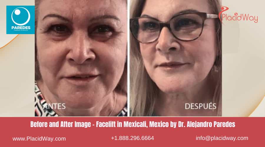 Facelift in Mexicali Mexico by Dr Alejandro Paredes