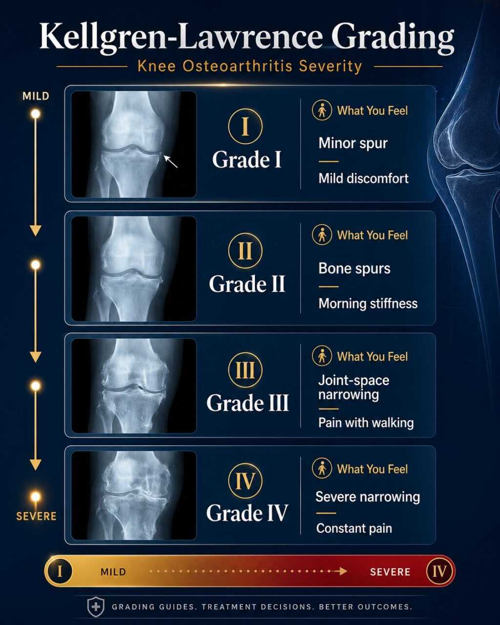 The Kellgren-Lawrence Grading System for knee Osteoarthritis.