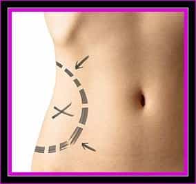 Gaining Weight After Plastic Surgery