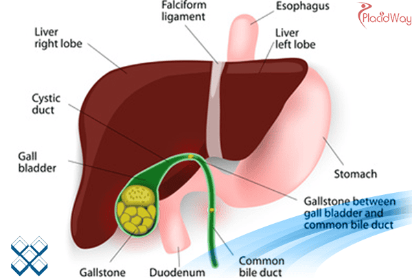 Laparoscopic Gallbladder Surgery in Italy