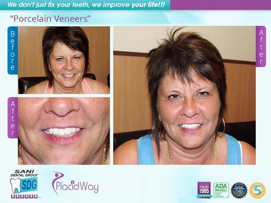 Before After Porcelain Veneers Testimonial in Los Algodones Mexico