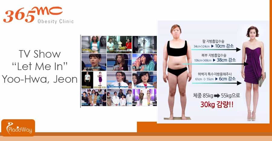 Before and After Surgery - Liposuction Clinic - Seoul, South Korea