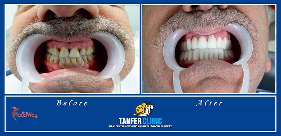 Dental Implants and Zirconium Porcelain Crowns in Turkey 