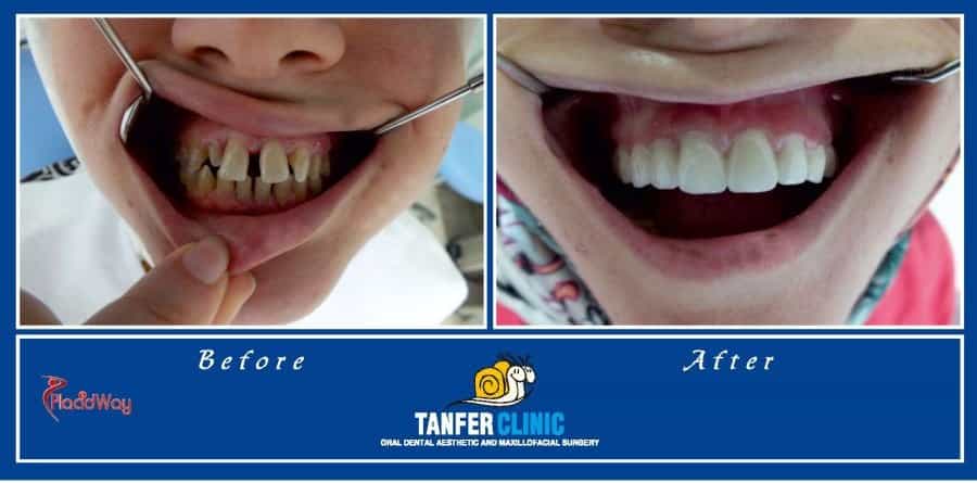 Dental Implants and Metal Porcelain Crowns Turkey