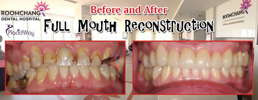 Full Mouth Reconstruction