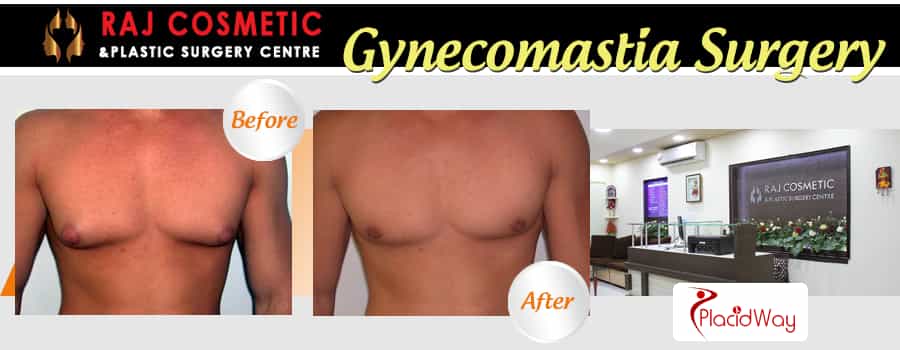 Gynecomastia Surgery Before and After Raj Cosmetic India