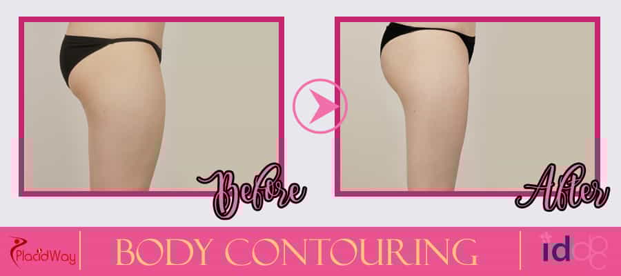 Body Contouring Before and After Picture in South Korea