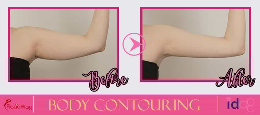 Patient Testimonial Body Contouring Surgery in Seoul, South Korea