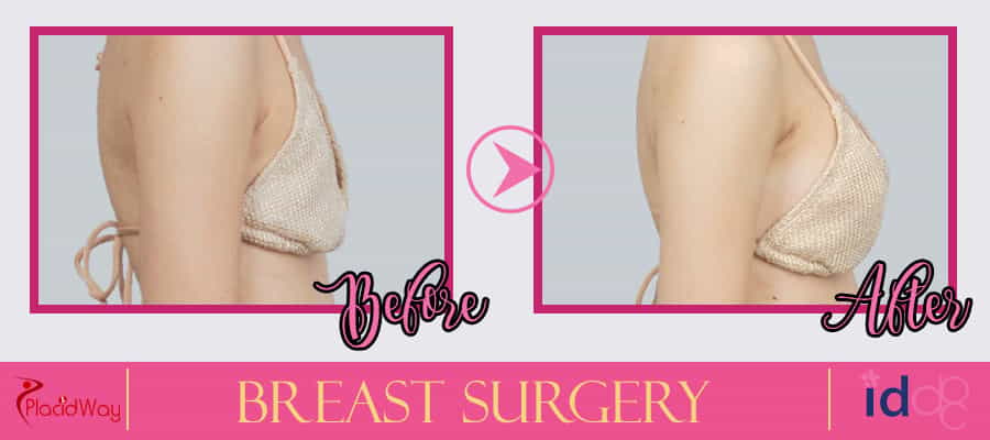 Patient Testimonial Breast Surgery in Seoul, South Korea