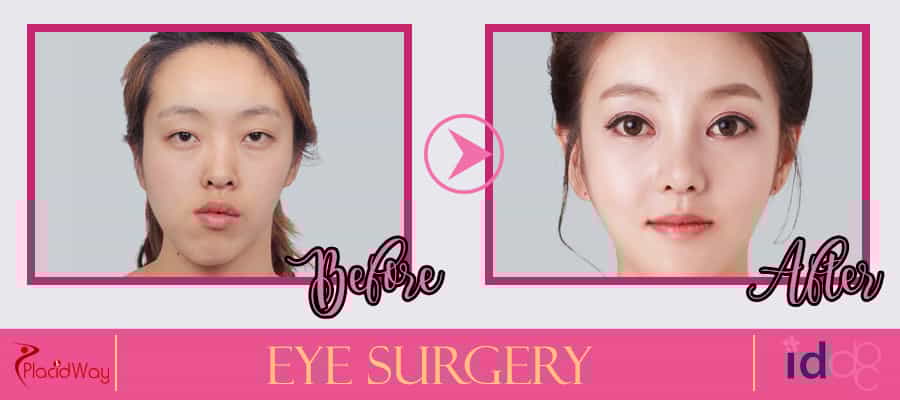 Eye Surgery Before and After South Korea