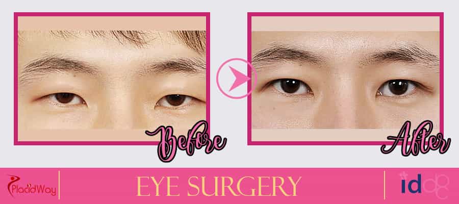 Eye Surgery Before and After Picture in Seoul South Korea