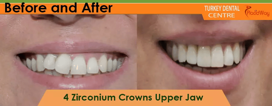 Corone in zirconio prima e dopo in Turchia Before and After Zirconium Crowns in Turkey