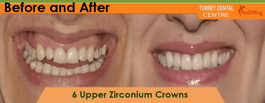 Corone in zirconio prima e dopo in Turchia Before and After Zirconium Crowns in Turkey