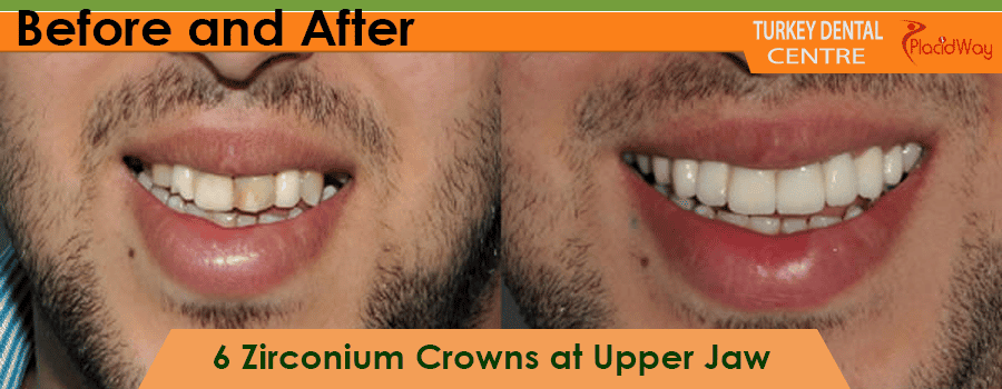 Corone in zirconio prima e dopo in Turchia Before and After Zirconium Crowns in Turkey