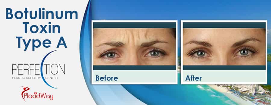 Before and After Botulinum Toxin Type A in Mexico Before and After Botulinum Toxin Type A in Mexico