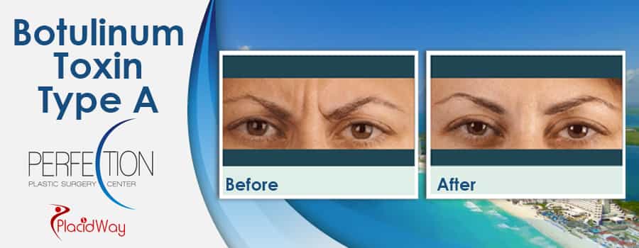 Patient Testimonials Botulinum Toxin Type A in Cancun, Mexico Patient Testimonials Botulinum Toxin Type A in Cancun, Mexico