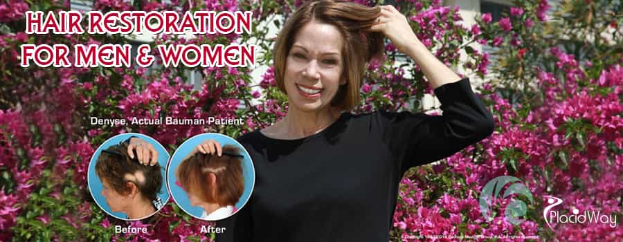 Antes y después de la restauración del cabello para hombres y mujeres en EE. UU. Before and After Hair Restoration for Men and Women in US