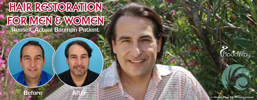 Antes y después del trasplante capilar FUE en EE. UU. Before and After FUE Hair Transplant in US