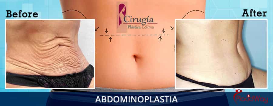 Testimonio de paciente de abdominoplastia en Colima, México