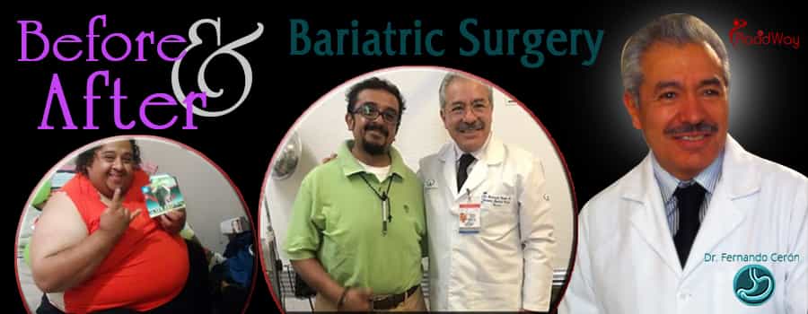 Testimonios de pacientes Cirugía de pérdida de peso en México