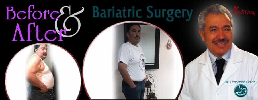 Antes y después de la cirugía bariátrica en Cancún, México Hombres después del procedimiento de obesidad