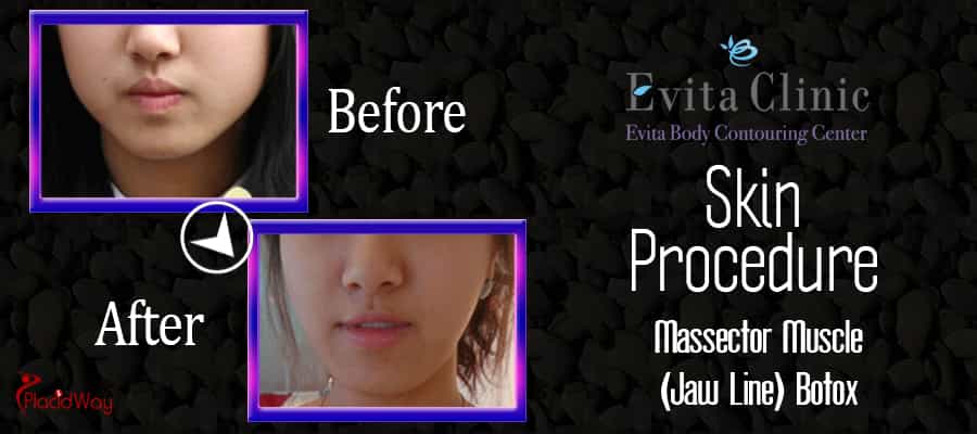 Botox Before and After Evita Clinic South Korea