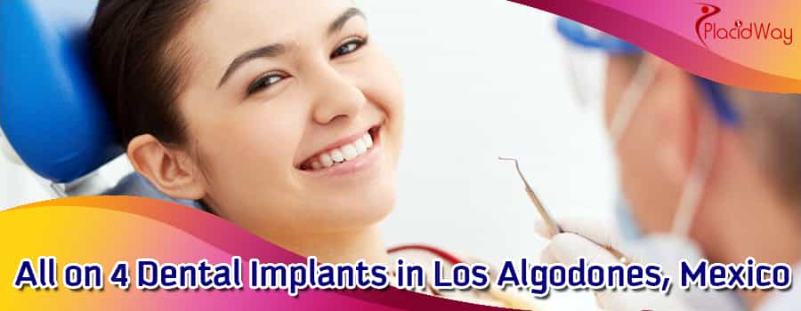 Todo sobre 4 Implantes Dentales en Los Algodonoes, México All on 4 Dental Implants in Los Algodonoes, Mexico