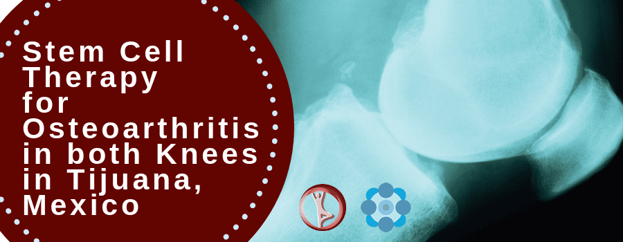 Stem Cell Therapy for Osteoarthritis in Tijuana Mexico