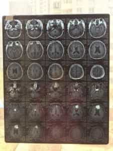 Post Mri Of Brain Tumor   X