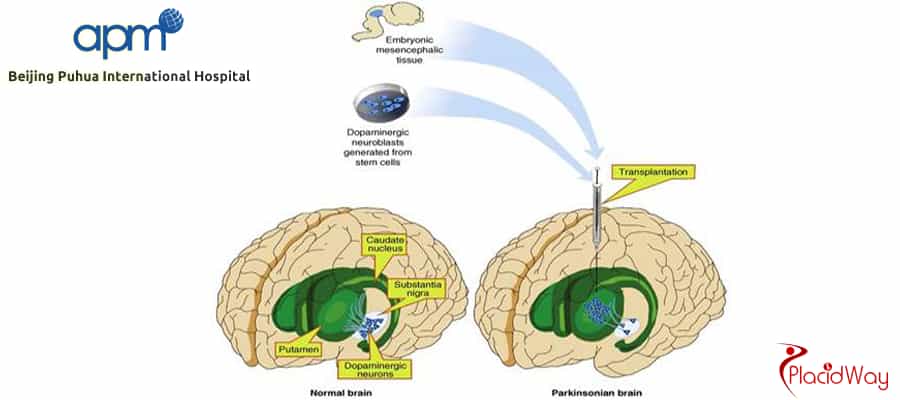 Stem Cell Therapy For Autism Treatment At Bpih In Beijing, China