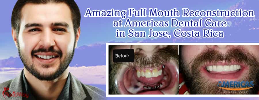 Amazing Full Mouth Reconstruction At Americas Dental Care In San Jose, Costa Rica
