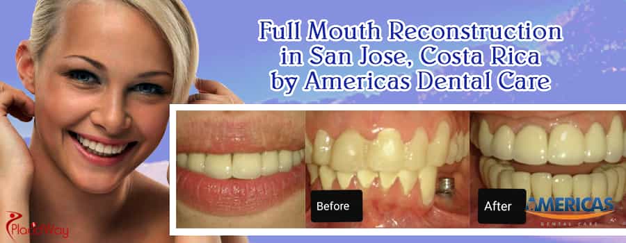 Full Mouth Reconstruction At Americas Dental Care In San Jose, Costa Rica