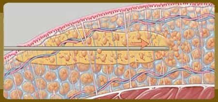 VASER Lipo System Working