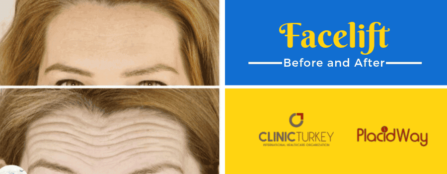 Face Lift Before and After in Turkey