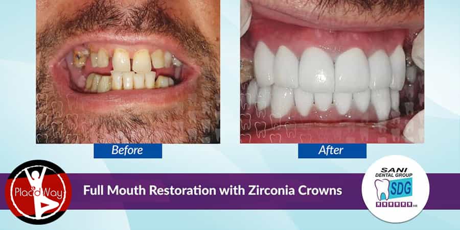 Before and After Dental Treatment in Sani Dental Group, Los Algodones, Mexico