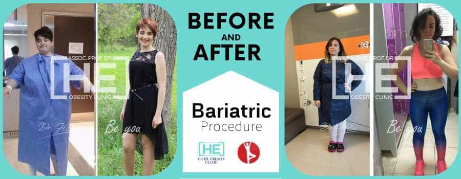 Before and After Stomach Bypass in Istanbul, Turkey - Dr HE Clinic