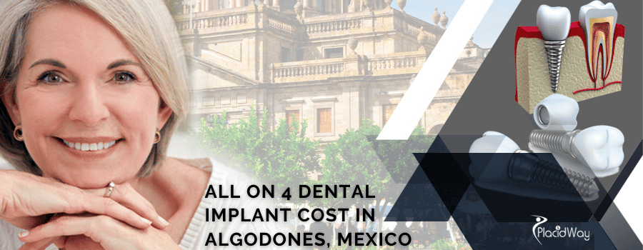 Costo de implantes dentales All on 4 en Algodones, México All on 4 Dental Implant Cost in Algodones, Mexico