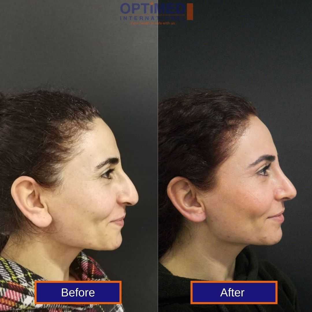 Rhinoplasty in Istanbul