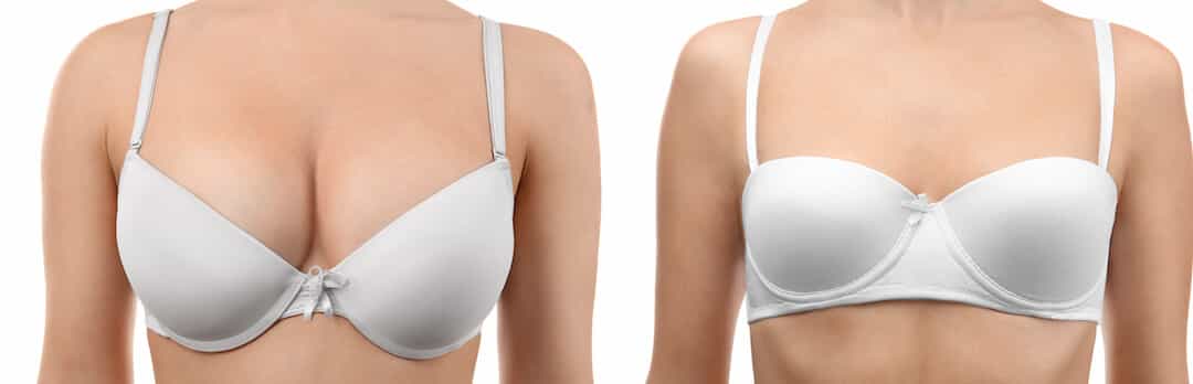 Breast Reduction