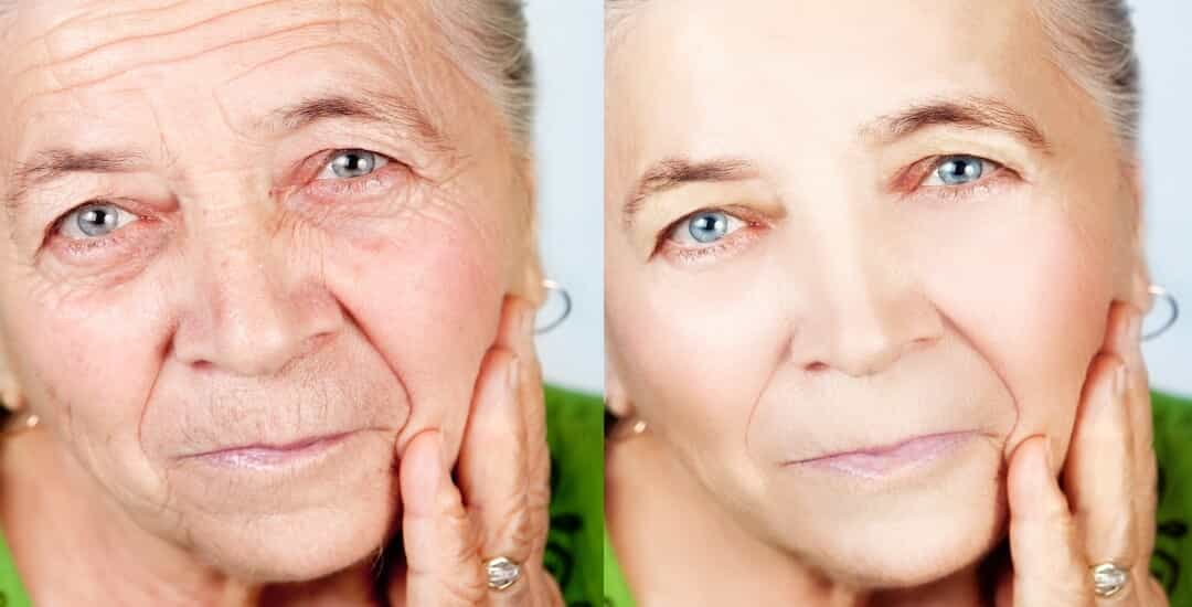 Facelift Necklift