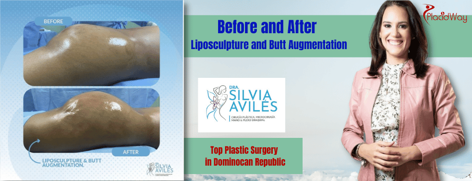 Before And After Liposculpture And Butt Augmentation